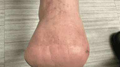 Amputación tras picadura de garrapata: Hombre de Ohio pierde cinco dedos por infección