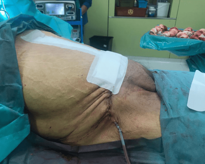 El abdomen de la paciente después de la cirugía. FOTO: American Journal of Case Reports
