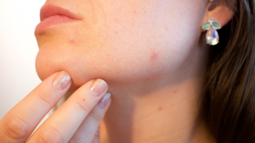 Lamentablemente en los adolescentes el acné puede causar baja autoestima además de angustia.(Pixabay.)