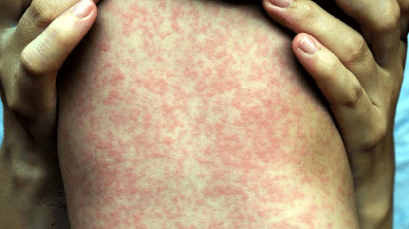 El sarampión es una enfermedad que aparece en niños, sin embargo, los adultos también se pueden contagiar.(Archivo)