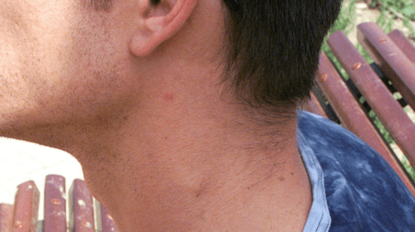 En el cuello, si existe infección, suele ser un lugar en el que aparecen inflamados los ganglios.(EFE/Juan Ferreras.)
