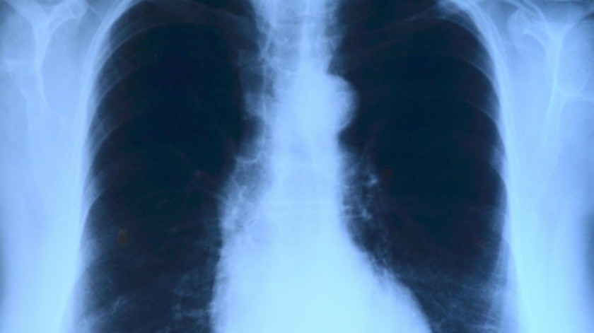 Solo el 20% de los pulmones registra las condiciones suficientes para un trasplante.