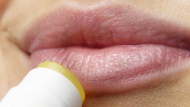¿Sufres de herpes labial? Toma nota de estos consejos