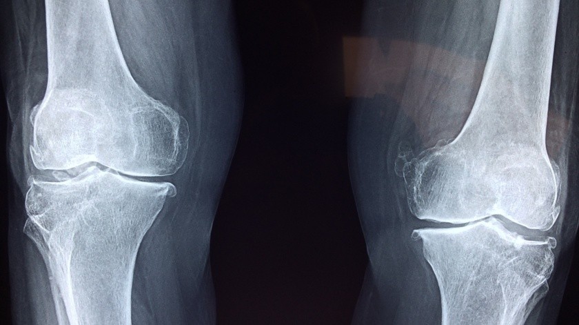 En general, el algoritmo predijo la osteoartritis con un 78% de precisión a partir de resonancias magnéticas realizadas tres años antes de la aparición de los síntomas.(Pixabay.)