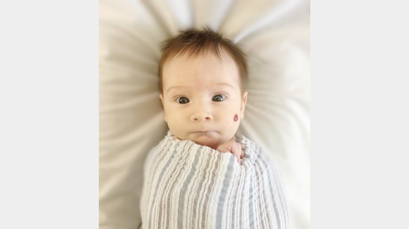 Los hemangiomas infantiles aparecen después del nacimiento de un bebé, por lo general dentro del primer mes. (Pixabay)