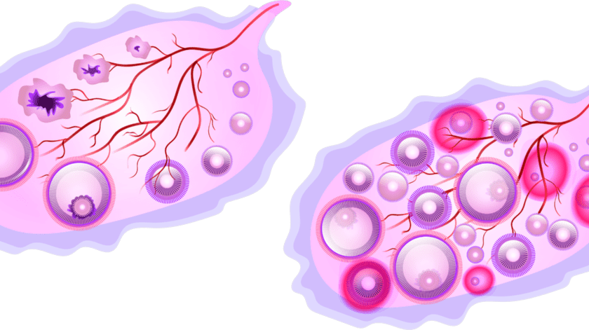 Los ciclos de ovulación con el Síndrome de Ovario Poliquístico, los ciclos de ovulación no se presentan todos los meses lo que lamentablemente puede contribuir con la infertilidad. (Pixabay.)