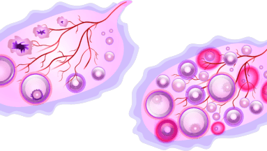 ¿A qué edades es más común la aparición del síndrome del ovario poliquístico?