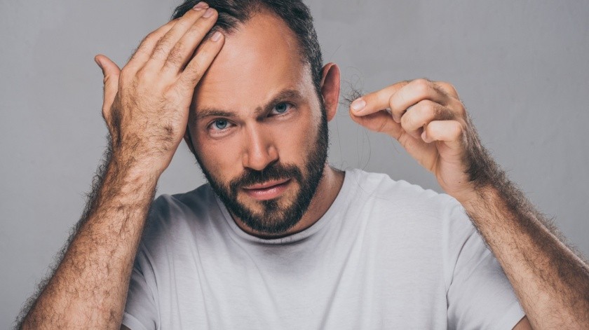 En una proporción del total de personas que padecen alopecia el 63% son hombres.(Pixabay)