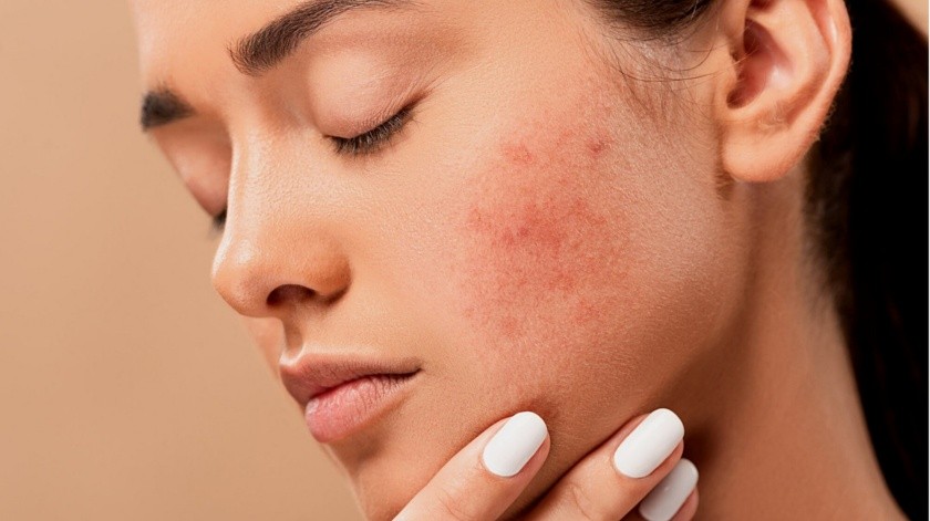 El acné también puede ser provocado por el rápido crecimiento de una bacteria llamada P. acnes(Pixabay)