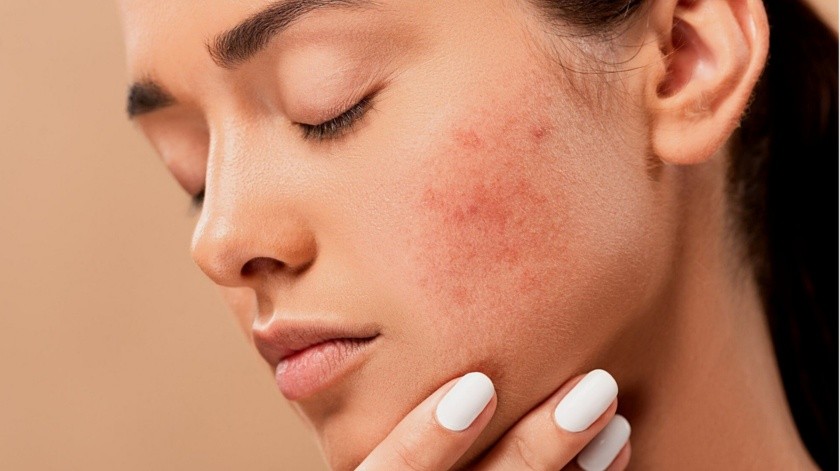Nunca toques el acné, así que lo mejor es dejar que la piel se cure de forma natural. Tocarse la piel durante el día puede provocar brotes.(Pixabay.)