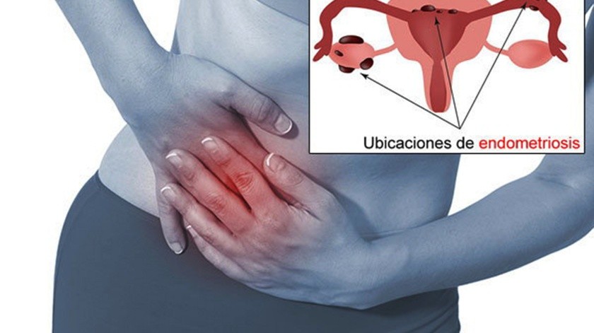 La endometriosis puede llegar a ser causa de infertilidad.(Cortesía UNAM)