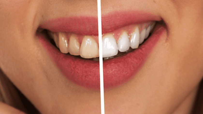 Diferentes causas pueden explicar las manchas amarillas en los dientes.(Pixabay)