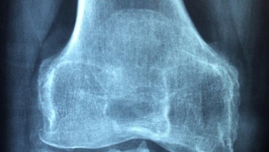 ¿Por qué algunas personas son más propensas a padecer de osteoporosis que otras?