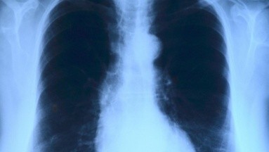 Expertos sugieren pruebas anuales en los pulmones a partir de los 50 años en fumadores