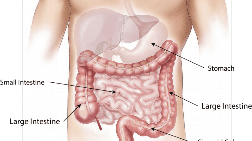 El cáncer colorrectal es un tumor procedente de las células del intestino grueso y del recto y puede desarrollarse a partir del crecimiento de protuberancias conocidas como pólipos.