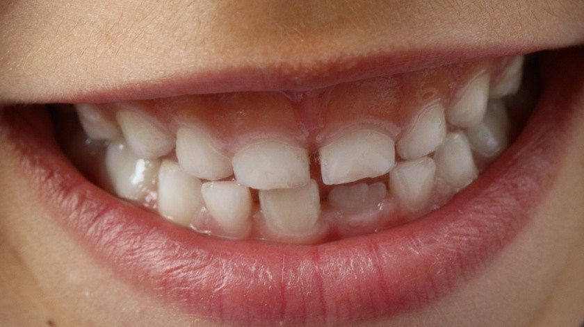 A los 10 y 12 años pierden los molares posteriores y se reemplazan con dientes permanentes aproximadamente a los 13 años. (Pixabay.)