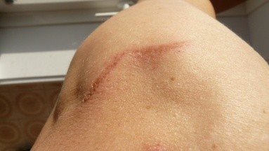 Cicatrices: Lo que no debes hacer para evitar que sean más visibles en la piel