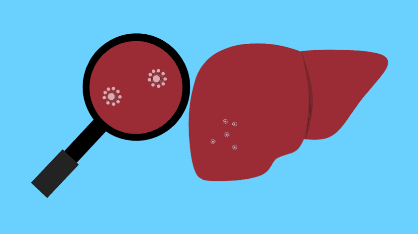 La hepatitis B es una infección contagiosa del hígado. Se transmite a través de la sangre o por fluidos corporales.(Pixabay)