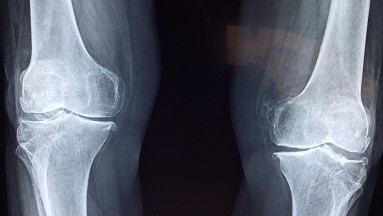 Osteoporosis: Toser fuerte o una leve tensión podría volverte vulnerable a fracturas