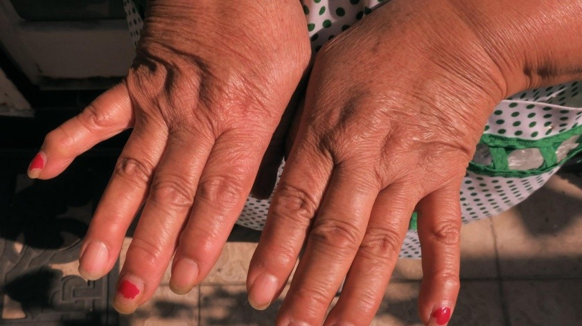 Los tratamientos para la artritis reumatoide ayudan a disminuir o detener el daño en articulaciones y reducir el dolor.(EFE.)