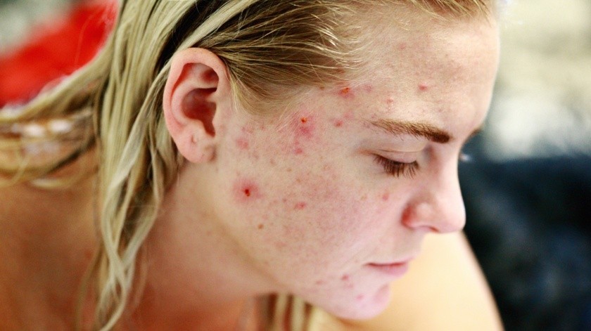 El acné quístico debe ser atendido a tiempo a fin de descartar otros problemas de salud.(Pixabay.)