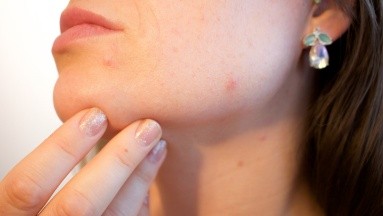 Si tu acné aumenta, especialista enumera algunos productos que debes reducir su ingesta