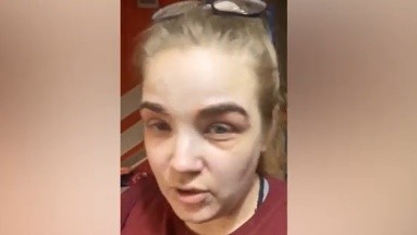 Mujer se aplicó tinte en las cejas y después se le inflamó el rostro; alega que fue la vacuna