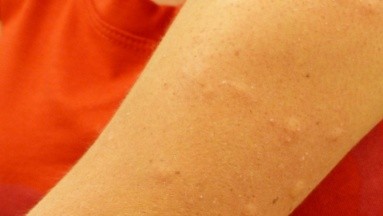 Alergia al sol severa: Revela que ella y una de sus hijas tienen rara condición