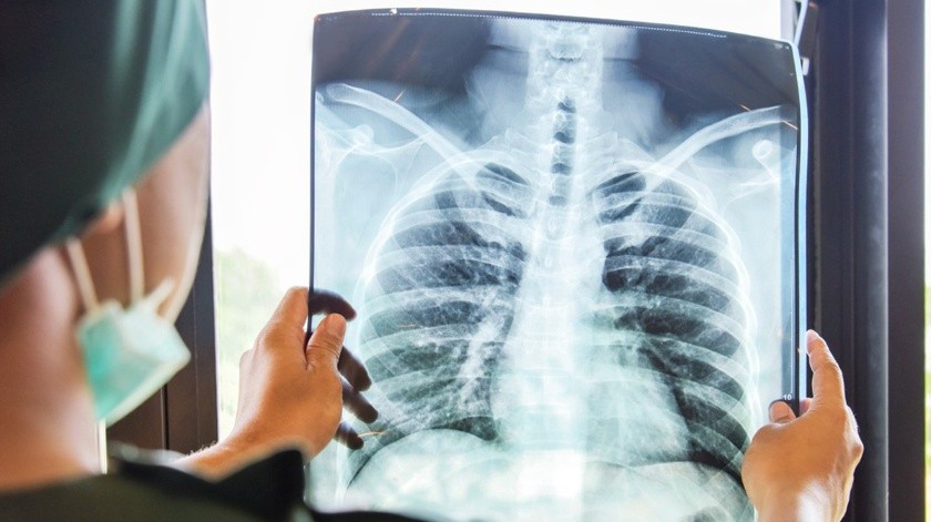 EPOC se le conoce a la Enfermedad Pulmonar Obstructiva Crónica(Cortesía)