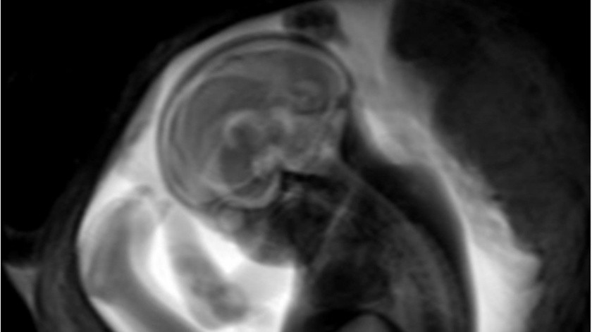 El Covid-19 de forma leve o moderada durante el embarazo no causa daños en el cerebro del feto, según estudio.(EFE)