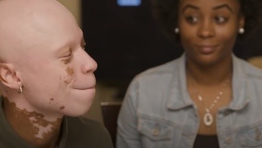 Una fuerte reacción a un medicamento le produjo vitiligo y alopecia