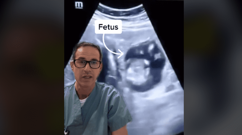 El médico compartió un video del ultrasonido de la joven donde se puede ver al feto en el hígado.(Captura.)