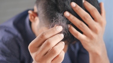 Caída del cabello es una secuela del Covid-19: Experto de la UNAM explica qué hacer