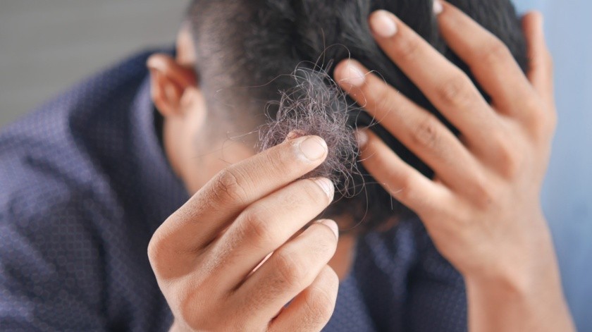 Algunos hombres y mujeres sufren de caída del cabello tras padecer Covid-19.(Unsplash)