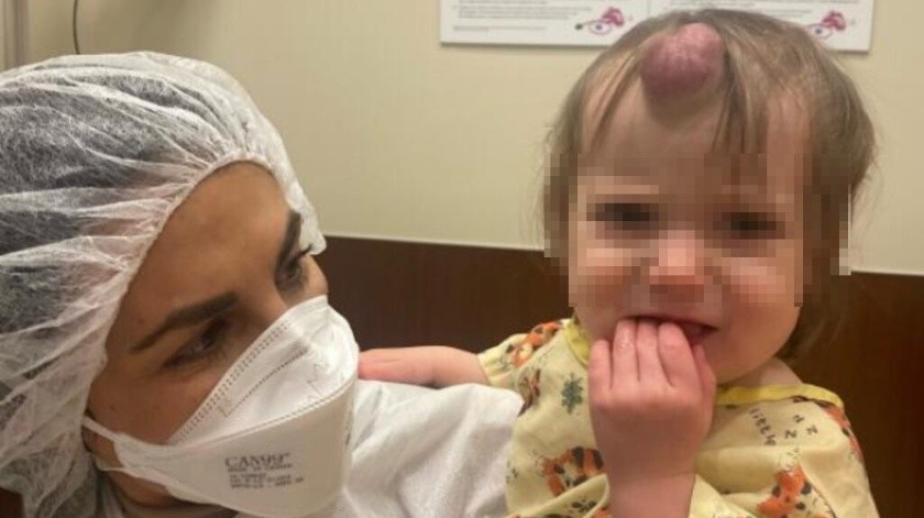 La pequeña fue sometida a una cirugía para retirar el hemangioma.(Mount Sinai)