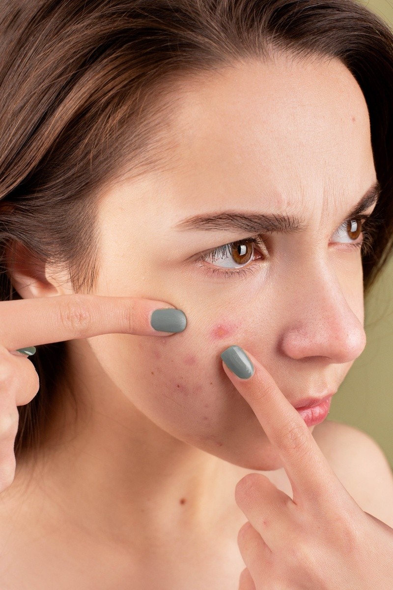 Las cicatrices del acné, pueden afectar el autoestima.  