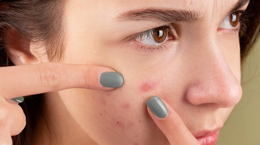 El estrés se ha relacionado con la aparición de acné.(Pexels)