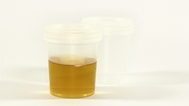 Incontinencia urinaria: Conoce cuáles son los cinco tipos