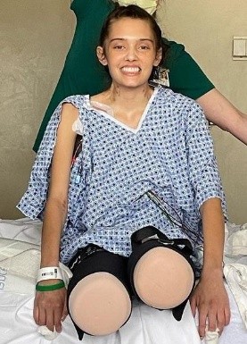 Modelo de 21 años perdió sus dos piernas tras sufrir complicaciones por Covid-19