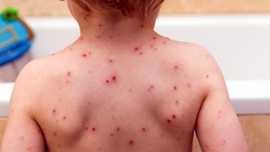 'Cóctel' de varicela y escarlatina  mantiene alerta en Reino Unido