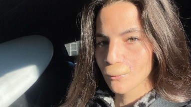 Brooklinn Khoury, la joven skateboarder perdió el labio superior tras ataque de un perro 