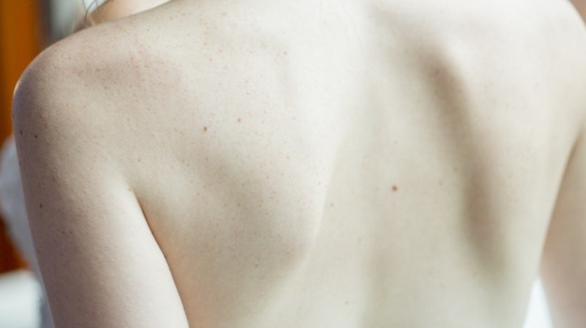 El cáncer de piel se puede prevenir.(Pexels.)