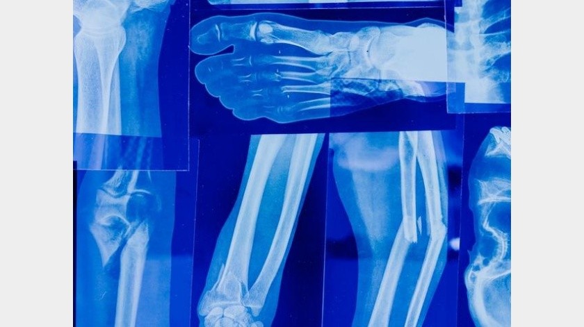La osteoartritis es el  daño o ruptura del cartílago articular entre los huesos.(Pexels.)