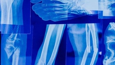 Para la osteoartritis, ¿la cinta kinesiológica podría ayudar ?