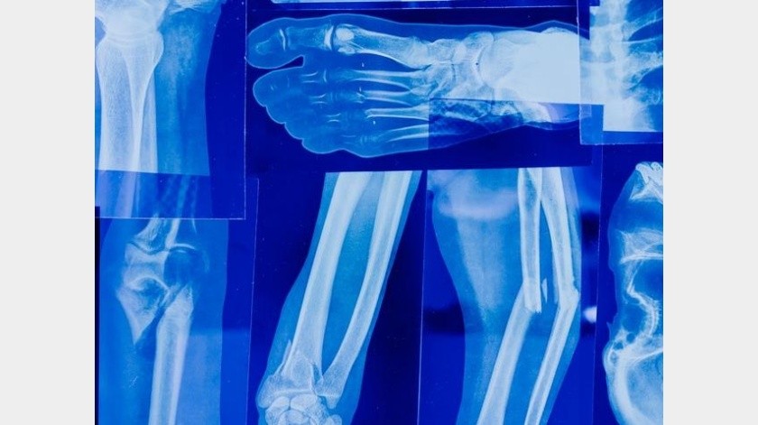 La artritis reumatoide debe ser tratada.(Pexels.)