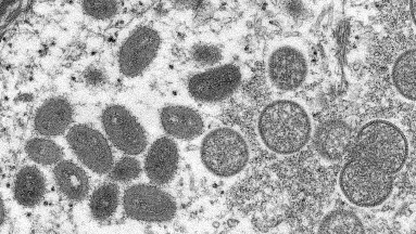 Con la viruela del mono, México descarta una pandemia ante número de casos