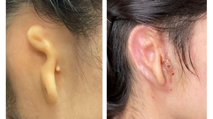 La paciente tuvo una cirugía de oreja 3D exitosa.(Arturo Bonilla, Microtia-Congenital Ear Institute)
