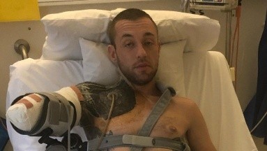 Joven hizo un mal levantamiento de pesas y le amputaron su brazo por una rara infección