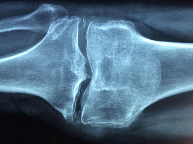 La osteoporosis puede dar a partir de edades avanzadas. Archivo GH.  