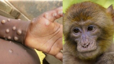 Viruela del mono sigue en aumento: ¿Se ha convertido en una emergencia sanitaria?